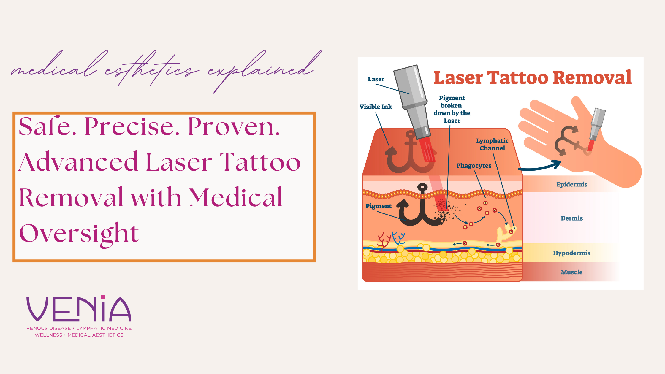 Safe laser tattoo removal CDA