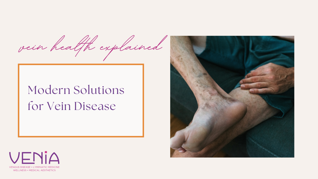 Saphenous Vein Reflux Treatment