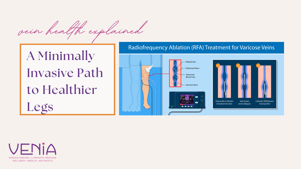 Radiofrequency Vein Ablation